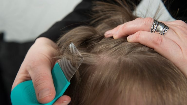 القمل في الشعر في المنام