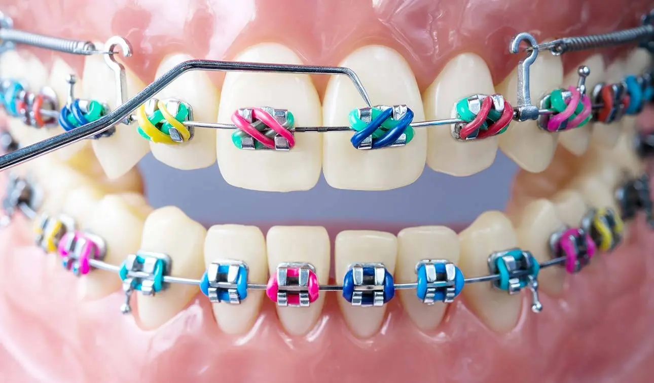  تقويم الاسنان - تفسير الاحلام