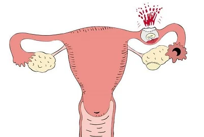 مين جربت اعراض الحمل خارج الرحم