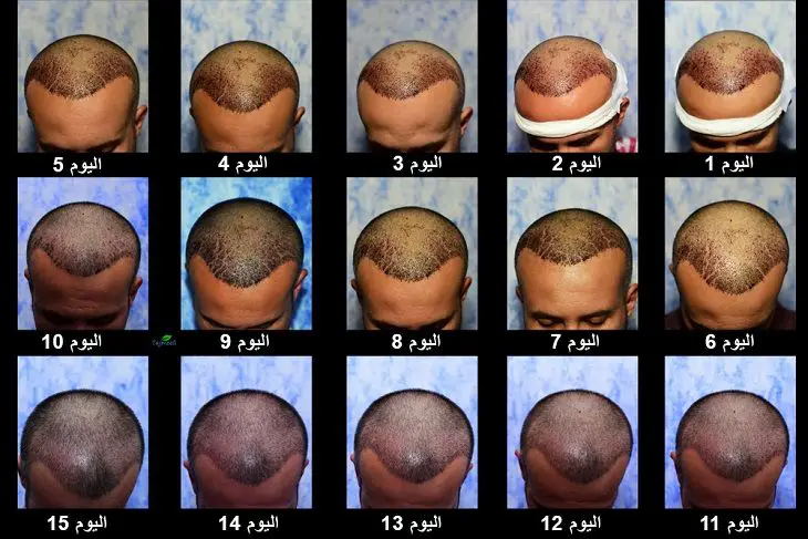 تجربتي مع زراعة الشعر بالصور