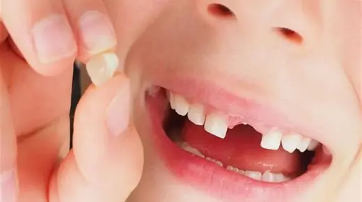 הפרשנות החשובה ביותר של 30 לאובדן שיניים בחלום מאת אבן סירין