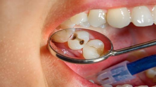 इब्न सिरिन द्वारा दंत क्षय के बारे में एक सपने की व्याख्या क्या है?