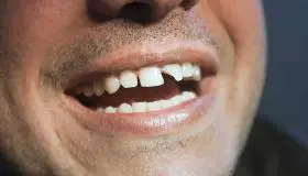 इब्न सिरिन के अनुसार टूटे हुए दांत के सपने की क्या व्याख्या है?