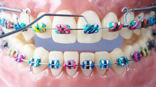 ما هو تفسير حلم تقويم الأسنان في المنام لابن سيرين؟
