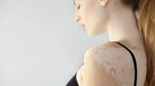 Rüyada elde vitiligo görmenin anlamları İbn Sirin